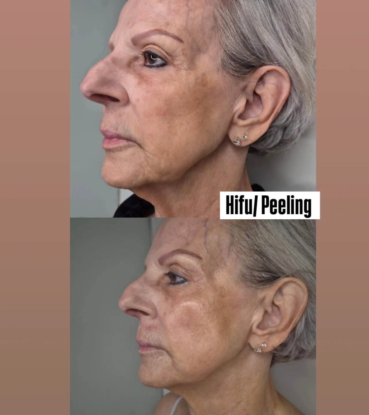 Collagen Stimulation